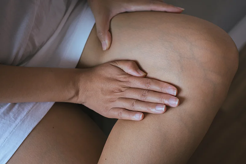 A woman presses her leg where she has spider vein issues