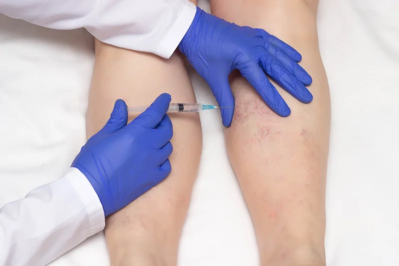 Sclerotherapy treatment from Aging Optimized